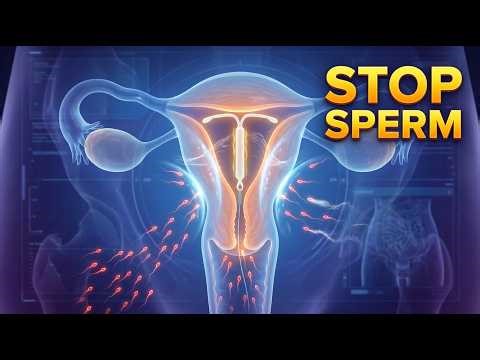 IUD: How to Prevent Pregnancy | 3D Medical Animation - Your Guide