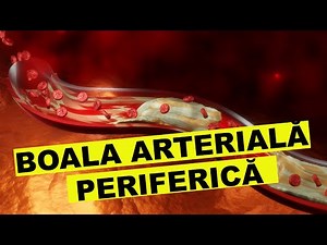 Peripheral arterial disease: diagnosis and treatment