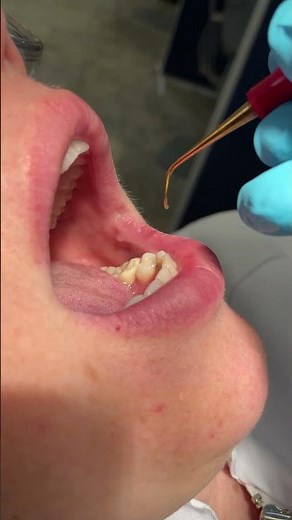 Why use a different Nevi?