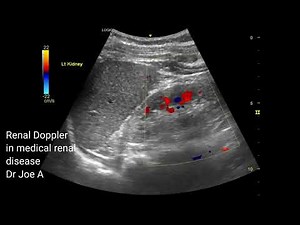Renal Doppler in medical renal disease: colour and spectral Doppler ultrasound video