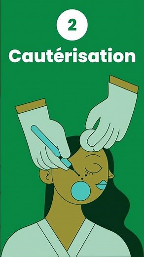 Quelles sont les différentes procédures chirurgicales pour enlever les acrochordons- Anavara limitée