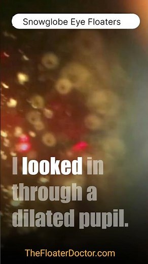 'Snowglobe' Eye Floaters: 100's of thousands of them