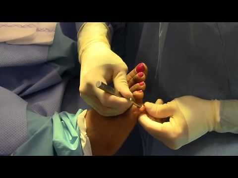 Hammer Toe 5th Digit Surgery - Dr. Nagler