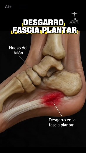 Recuperación del desgarro de la fascia plantar
