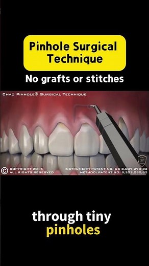 Long-Term Success: 17 Years After Pinhole® Treatment