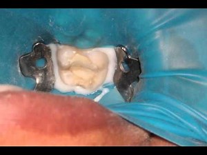 Root canal treatment in a severe tooth abscess