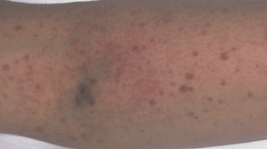 Rare blood auto immune disorder appearing in very small amount of COVID vaccine recipients