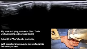 Percutaneous Carpal Tunnel Release with Ultrasound Guidance - Wide Awake, No Anesthesia