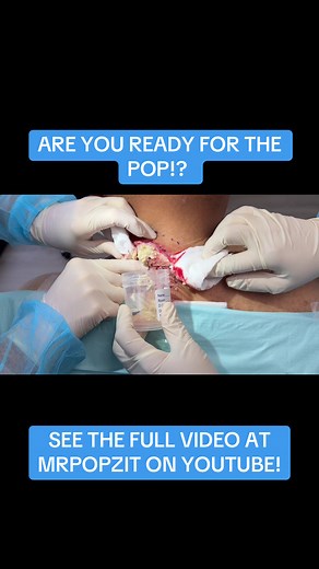 You’re not ready for all this pop! Relieving pressure from the neck gives instant relief to my patient. See the entire removal and closure at MrPopZit on YouTube! #mrpopzit #mpzdermatology #popaholic #cysts #pop