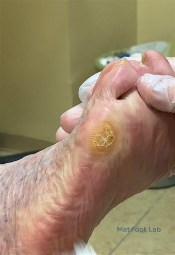 Ablation of plantar hyperkeratosis in a forefoot varus condition. Targeted debridement to reduce pressure, relieve pain, and restore functional load distribution in the forefoot. 👣🩺 #podiatry #footcare #hyperkeratosis #plantarcare #forefootvarus
