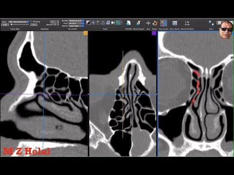 Uncinate Process Attachments