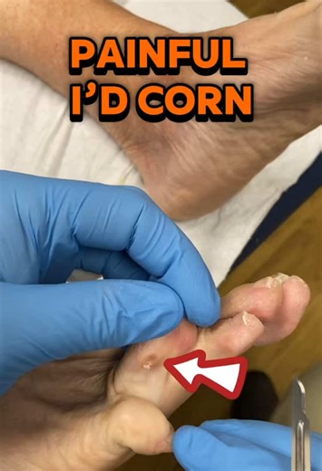 Understanding and Treating Painful Corns Between Toes