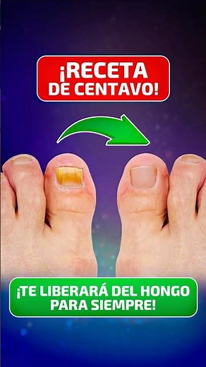 🦶✨ Forget about fungus forever with this home remedy #healthandlongevity