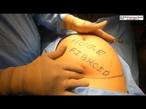 First in the World 3.5 Kg Fibroid, Ovarian Cyst, Gallbladder & Appendix Removed by Laparoscopy • Video • MEDtube.net