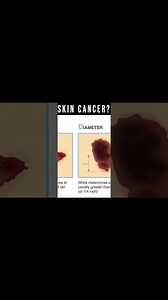 What Does Skin Cancer Look Like? [Symptoms, Pictures, Types]