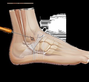 Arthrex® Brostrom Repair