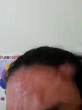 Subgaleal hemorrhage