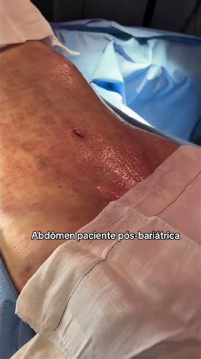 ABDOMINOPLASTIA PÓS-BARIÁTRICA: O incrível antes e depois! 😱✨