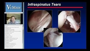Diagnostic Arthroscopy for Rotator Cuff Tears