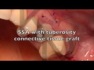 SSA with tuberosity connective tissue graft
