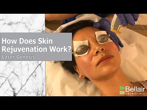 How does Laser Genesis work?