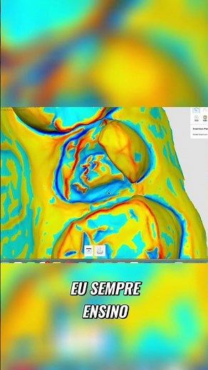 Aprenda a usar a plataforma Medit para criar coroas, onlays, inlays e facetas e imprimir tudo isso!!