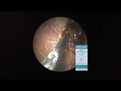Huge dry nasal crust removal