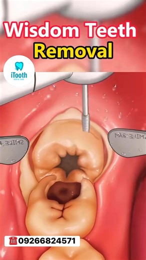 Your wisdom teeth might be the last to grow, but they can cause the most trouble! 😬 Learn when to watch out for signs like pain or swelling — and when it’s time for removal 💡 Visit iTooth Dental Clinic for a proper check-up and advice from our friendly dentists 🦷💙 #iToothDentalClinic #WisdomTooth101 #DentalFacts #OralHealthAwareness #HealthySmile” | ITooth Dental Clinic