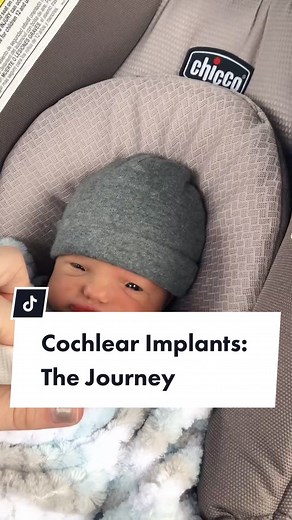 The Magic of Cochlear Implants: What Happens After Activation Day