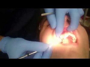 Clear Braces - Bonding procedure