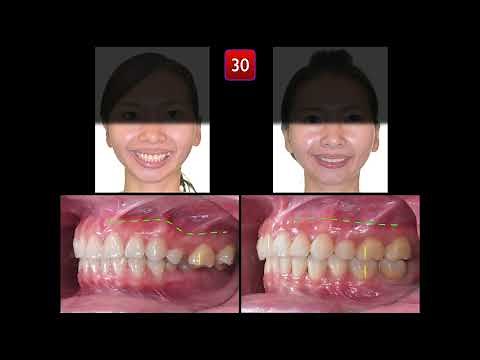 Posterior X-bite, part II |【Chris Chang Ortho】CC830