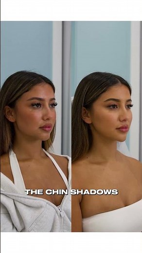 Chin Shadows & Masseters - Ep 4 – Dr Tony Truong POV
