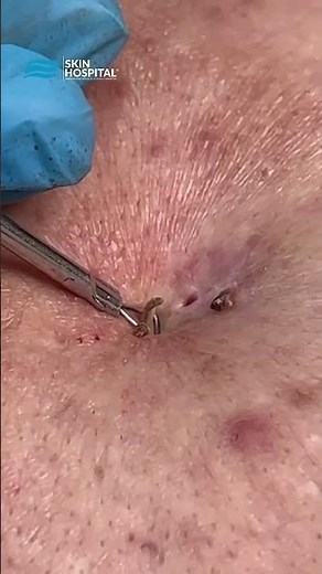 Extracción de comedones (puntos negros) | Skin Hospital | #puntosnegros