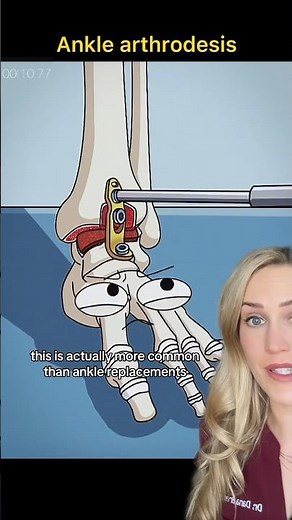 Doctor explains: ankle fusion surgery