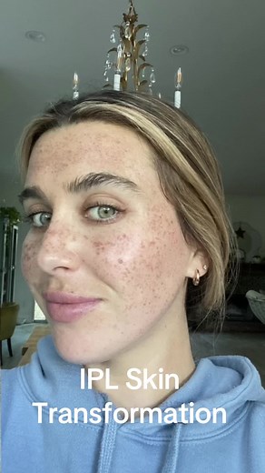 IPL Freckle Removal: My Skin Transformation Journey