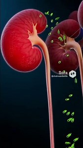 Bacterial Kidney Infection #shortvideo Pyelonephritis