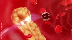 Nanobot finds and removes forming cholesterol plaque, abstract conceptual 3d animation. full HD 1080 Stock Video