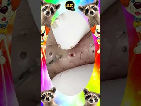 Huge blackhead removal from nose/ old aged blackheads removal/ cystic blackheads whiteheads removal