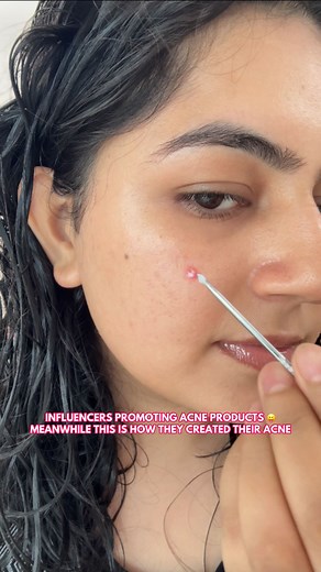 277K views · 11 reactions | Also, my real acne crying in the corner: “Avaiyin hi itni mehnat kar rahe hain hum ” . . . #skin #skincare #skincarecommunity #skincareproducts #oilyskincare #dryskincare #acne #acneskin #acneproneskin #realskin #explorepage #foryoupage | SkinCarey Ing | Facebook