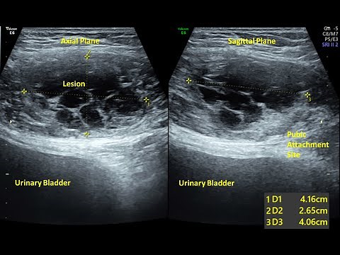 Rectus Abdominis Muscle Tear - Ultrasound