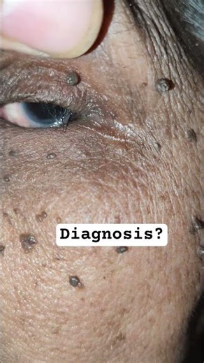 Entropion is a condition where the eyelid turns inward, causing eyelash to rub against Cornea.#eyes