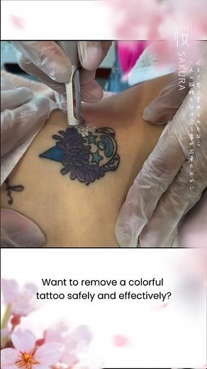 Color Tattoo Removal with Q-Switch Laser: Safe, Precise & Effective