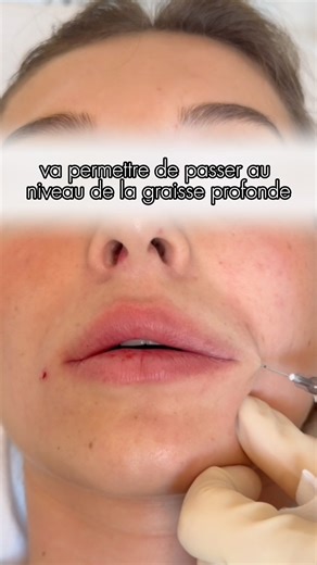 Docteur Cécile Winter on Instagram: "Comment se déroule une injection des lèvres ? Avant toute chose, une anesthésie locale est réalisée pour assurer un maximum de confort. Pas d’aiguille au départ, mais une canule très fine. ➡️ Elle ne pique pas, ne blesse pas, et limite les bleus. Elle permet d’injecter en profondeur, là où le volume se perd avec le temps, tout en respectant les muscles et les vaisseaux. Ensuite, une fine aiguille est utilisée pour travailler la hauteur de la lèvre, en surfac