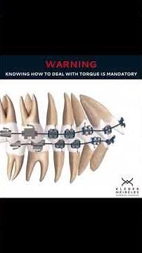 REAL NEUTRAL TORQUE incorporates a crown NEGATIVE RELATIVE TORQUE - ORTHODONTIC TIPS #Shorts