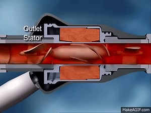 HeartMate II™ LVAD - Funktion on Make a GIF