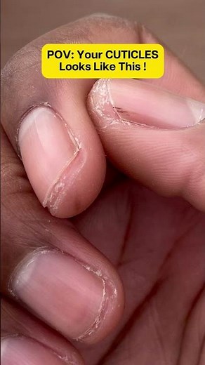 How to fix your cuticles