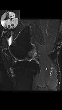 MRI reporting - medial meniscus tear and a perimeniscal cyst