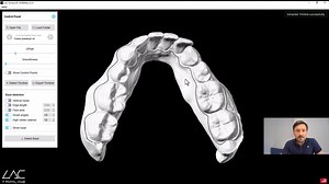 AutoTrim - Automatic cutting line calculation for aligner production!