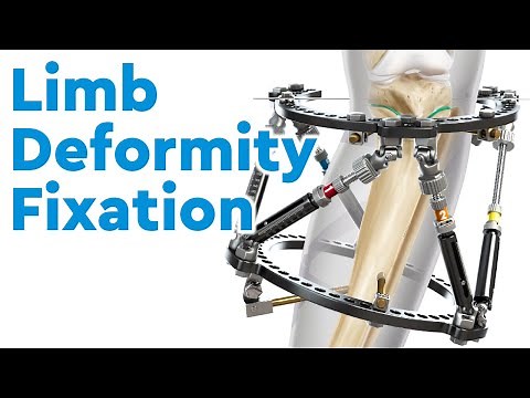 Treatment for Limb Deformities in Children