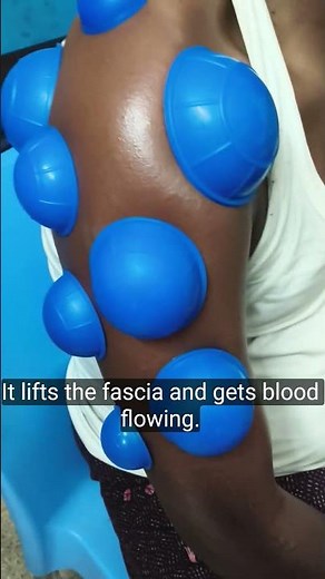 Shoulder Pain? Try Silicone Cupping!Silicone Cupping Amazing Results#geethamihi#shorts